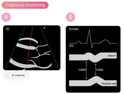 fractional shortening normal range.